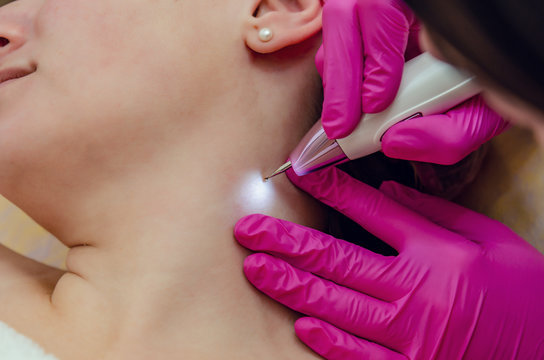 Hawley Health Centre - Skin Tag/Milia Removal